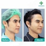 Before and after deep plane facelift results at Intrarat Hospital, visible facial contour improvement