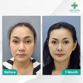 Before and after Deep Plane Facelift results at Intrarat Hospital, visible facial rejuvenation