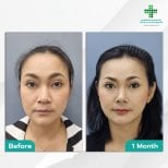 Before and after Deep Plane Facelift results at Intrarat Hospital, visible facial rejuvenation