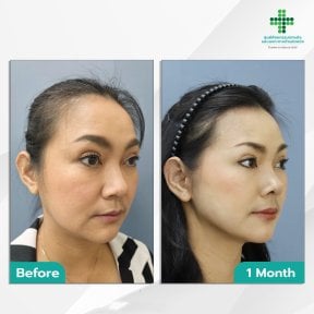 Before and after deep plane facelift results at Intrarat Hospital – visible facial rejuvenation