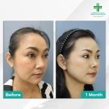 Before and after deep plane facelift results at Intrarat Hospital – visible facial rejuvenation