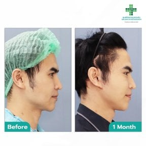 Before and after deep plane facelift results at Intrarat Hospital, visible facial contour improvement