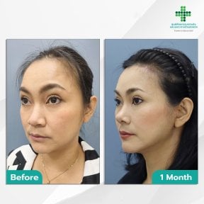 Before and after Deep Plane Facelift results at Intrarat Hospital, visible facial rejuvenation