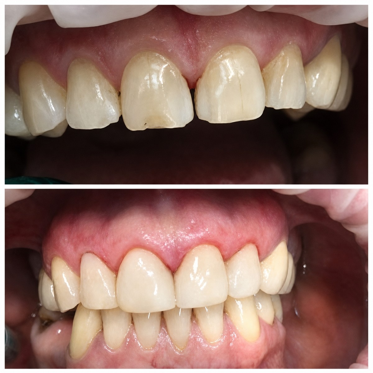 Resultados antes y después de restauración dental (bonding) en Casa Dental, s.r.o.