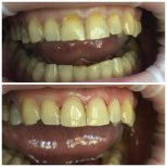 Resultado antes y después de restauración dental (bonding) en Casa Dental, s.r.o. – sonrisa mejorada