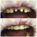 Before and after dental crown installation at Casa Dental, s.r.o. – restored front teeth result
