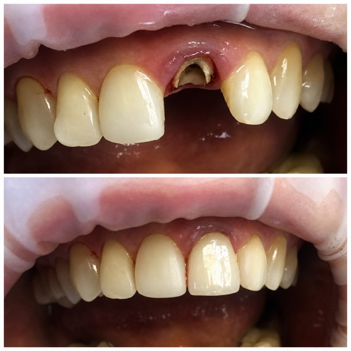 Resultado antes y después de la corona dental en Casa Dental, s.r.o. para diente frontal
