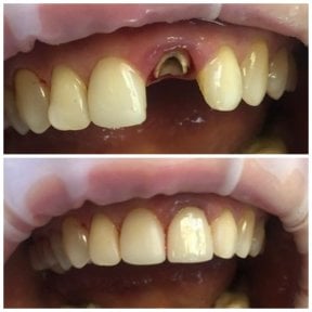 Before and after dental crown installation result at Casa Dental, s.r.o. for front tooth repair