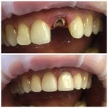 Before and after dental crown installation result at Casa Dental, s.r.o. for front tooth repair