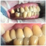 Before and after dental crown installation at Casa Dental, s.r.o., improved smile result
