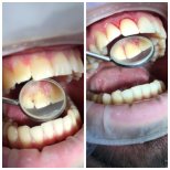 Efekt przed i po głębokim czyszczeniu (skaling i wygładzanie) w Casa Dental, s.r.o.
