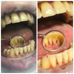 Resultados antes y después de limpieza profunda en Casa Dental, s.r.o.