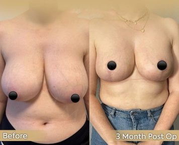 Before and after breast reduction results at Dr. Safa Manav Clinic, 3 months post-op