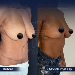 Before and after breast reduction results at Dr. Safa Manav Clinic, 2 months post-op