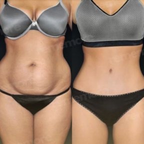 Vorher-nachher-Ergebnis Bodylift bei Memorial Göztepe Hospital, verbesserte Körperkontur