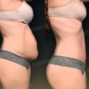 Vorher-nachher-Ergebnis Bodylift bei Memorial Göztepe Hospital, verbesserte Körperkontur