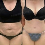 Vorher-nachher-Ergebnis Bodylift bei Memorial Göztepe Hospital, verbesserte Bauchkontur