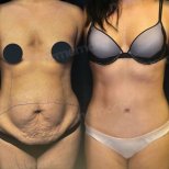 Vorher-nachher-Ergebnis Bodylift bei Memorial Göztepe Hospital, verbesserte Körperkontur