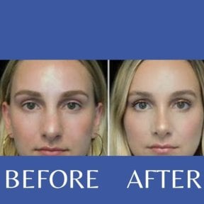 Before and after closed rhinoplasty results at ID Clinic Bangkok, nose reshaping improvement