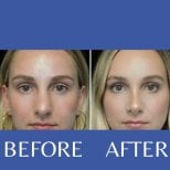 Before and after closed rhinoplasty results at ID Clinic Bangkok, nose reshaping improvement