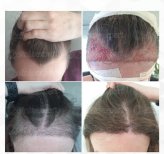 نتائج زراعة الشعر قبل وبعد في CE International Hospital، استعادة خط وكثافة الشعر