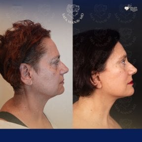 Vorher-nachher-Ergebnis Deep Plane Facelift bei Dr. Safa Manav Clinic, sichtbare Verjüngung