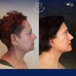 Vorher-nachher-Ergebnis Deep Plane Facelift bei Dr. Safa Manav Clinic, sichtbare Verjüngung
