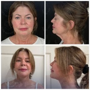 Vorher-nachher-Ergebnis Deep Plane Facelift bei Dr. Safa Manav Clinic, Gesichtsverjüngung