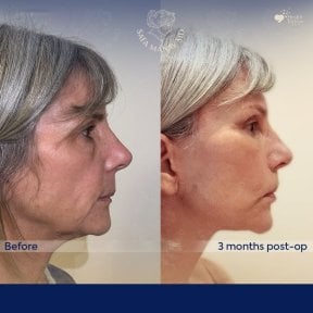 Vorher-nachher-Ergebnis Deep Plane Facelift bei Dr. Safa Manav Clinic, sichtbare Verjüngung