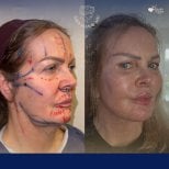 Vorher-nachher-Ergebnis Deep Plane Facelift bei Dr. Safa Manav Clinic, Gesichtsverjüngung