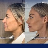 Vorher-nachher-Ergebnis Deep Plane Facelift bei Dr. Safa Manav Clinic, sichtbare Verjüngung
