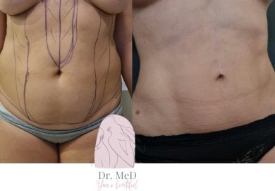Before and after liposuction results at Dr. MED – visible abdominal contour improvement