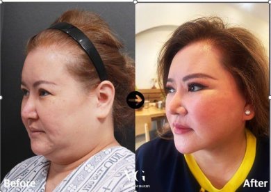 Vorher-nachher-Ergebnis Deep Plane Facelift bei VG Plastic Surgery, verbesserte Gesichtskontur