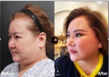 Vorher-nachher-Ergebnis Deep Plane Facelift bei VG Plastic Surgery, verbesserte Gesichtskontur