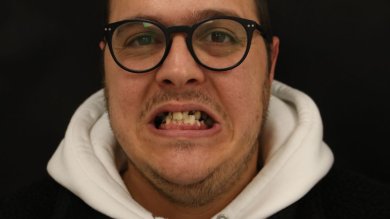 Vor All-on-6 Zahnimplantaten bei Excelentis Dental Center, fehlende und beschädigte Zähne sichtbar