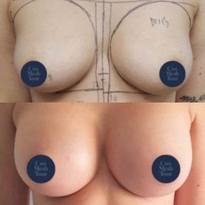 Before and after breast lift results at ID Clinic Bangkok, improved breast contour and lift
