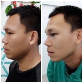 Before and after rhinoplasty result at ID Clinic Bangkok, improved nose shape and profile