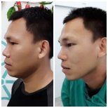 Before and after rhinoplasty result at ID Clinic Bangkok, improved nose shape and profile