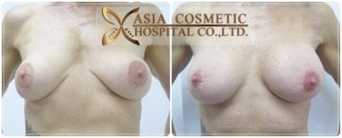 Before and after breast reduction results at Asia Cosmetic Hospital, improved breast shape