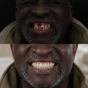Vorher-nachher-Ergebnis All-on-4-Implantate bei Excelentis Dental Center, Lächeln restauriert