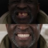Vorher-nachher-Ergebnis All-on-4-Implantate bei Excelentis Dental Center, Lächeln restauriert