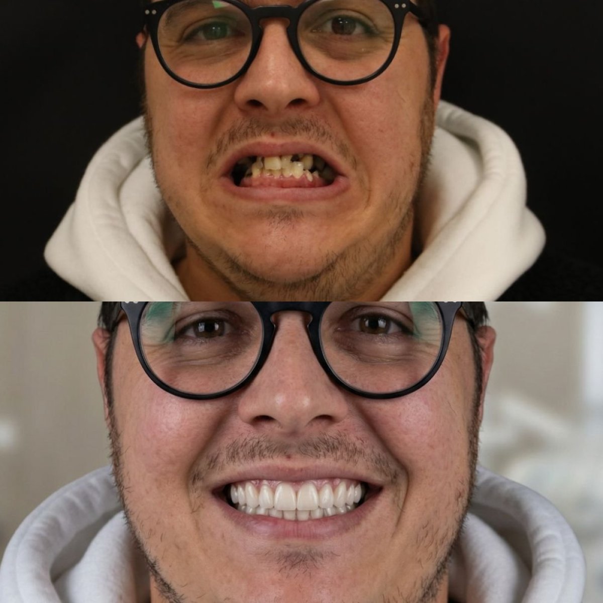 Resultados antes y después de implantes All-on-4 en Excelentis Dental Center, restauración de sonrisa