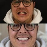 Результат до и после имплантации All-on-4 в Excelentis Dental Center, восстановление улыбки