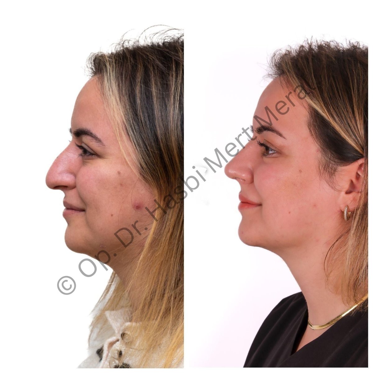 نتائج عملية تجميل الأنف قبل وبعد مع Dr. Hasbi Mert Meral، تحسين شكل الأنف