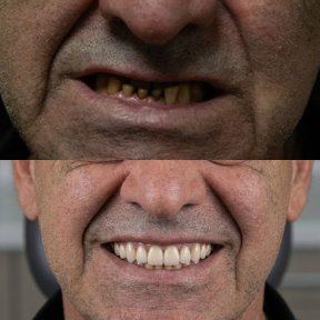 Vorher-nachher-Ergebnis All-on-4-Implantate bei Excelentis Dental Center, Lächeln wiederhergestellt