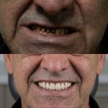 Vorher-nachher-Ergebnis All-on-4-Implantate bei Excelentis Dental Center, Lächeln wiederhergestellt