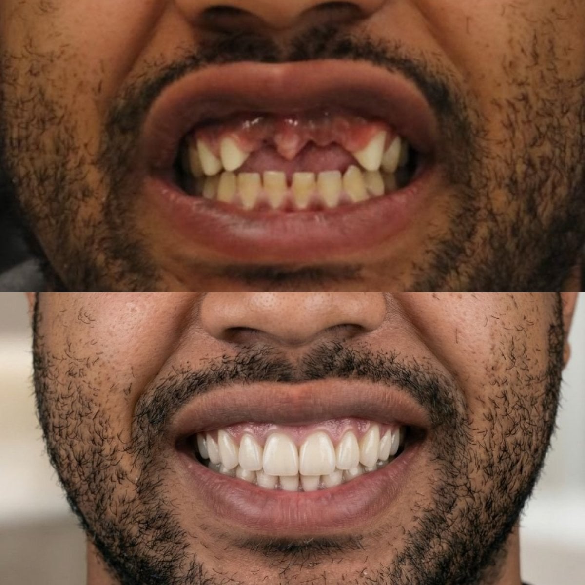 نتائج زراعة الأسنان قبل وبعد في Excelentis Dental Center – ابتسامة طبيعية مستعادة