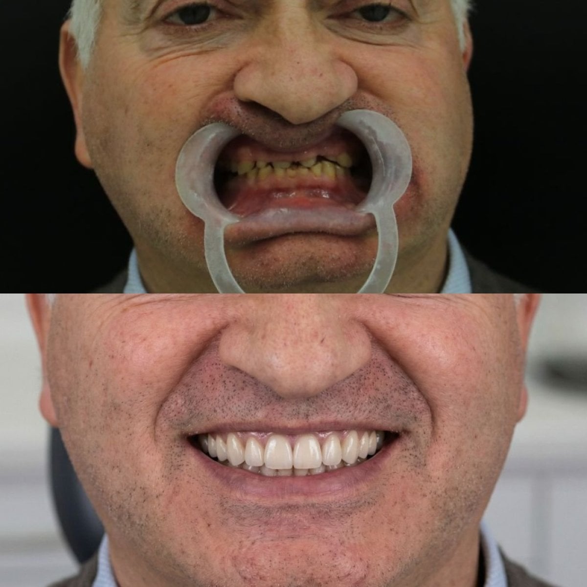 نتيجة قبل وبعد زراعة الأسنان All-on-6 في Excelentis Dental Center، استعادة الابتسامة