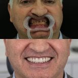 Vorher-nachher-Ergebnis All-on-6-Implantate bei Excelentis Dental Center, Lächeln restauriert