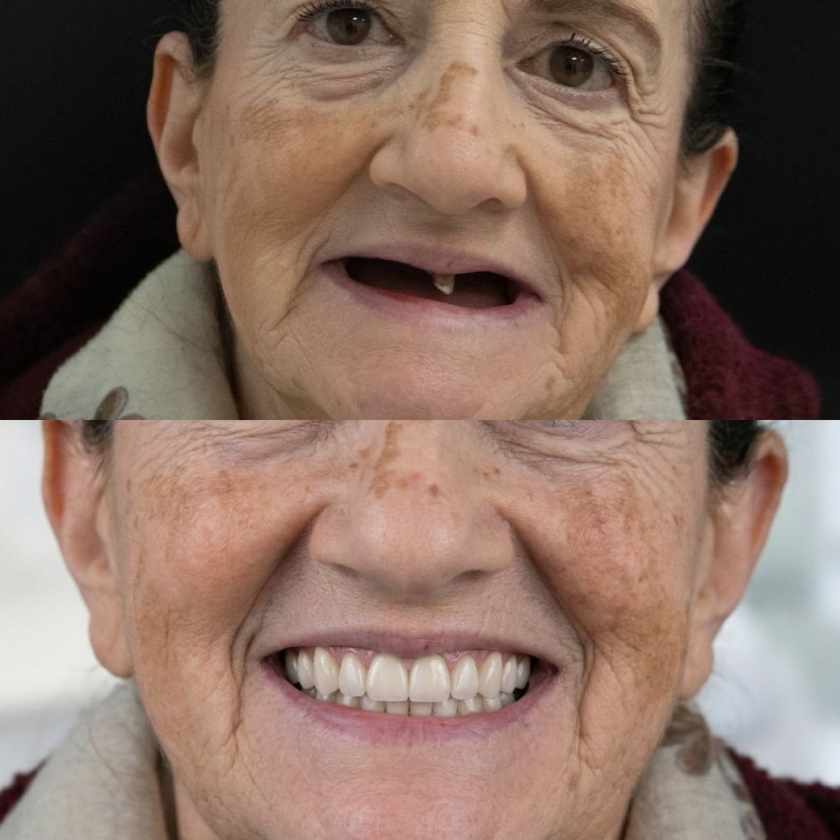 Resultados antes y después de implantes All-on-6 en Excelentis Dental Center, restauración de sonrisa